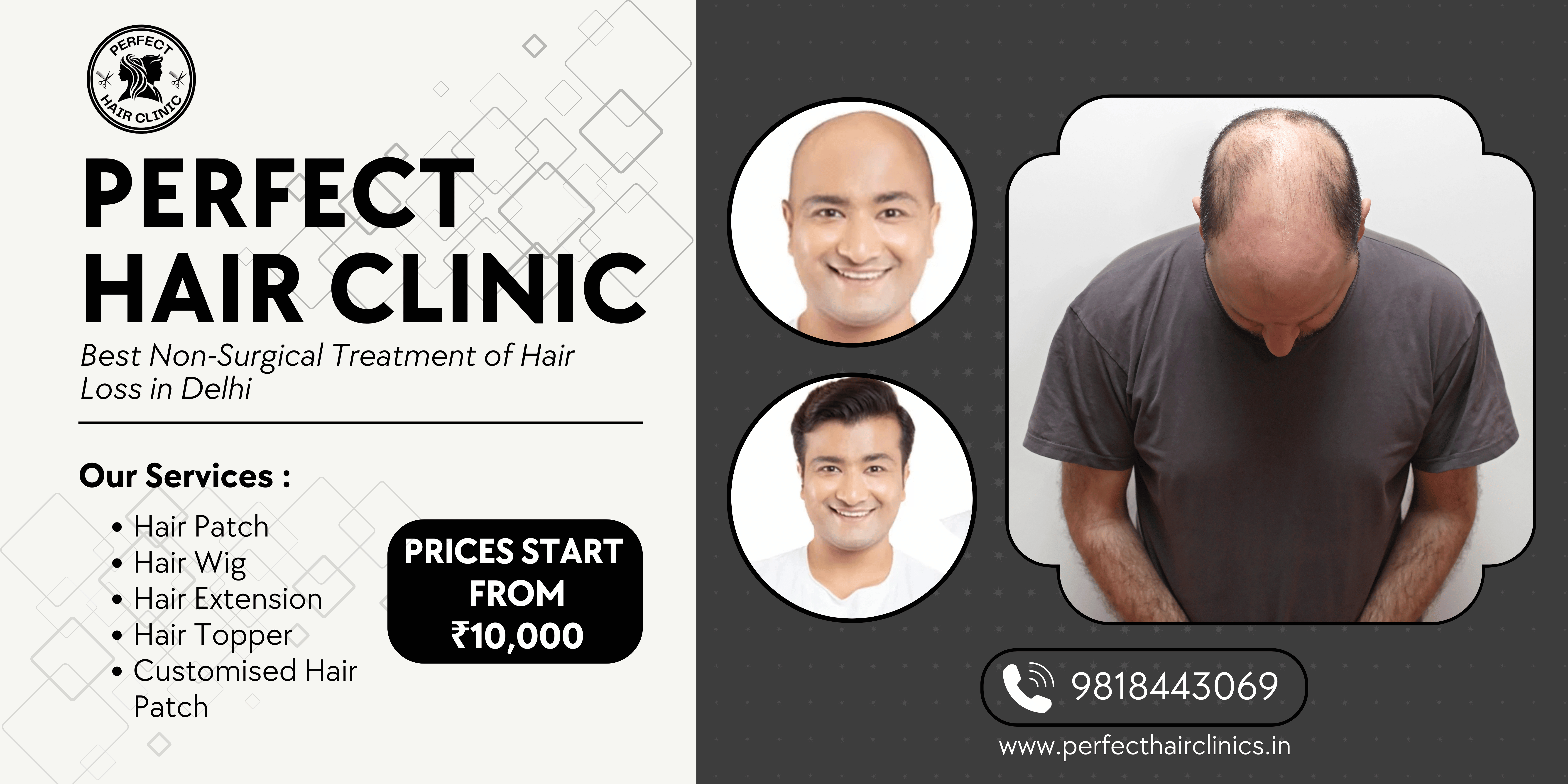 Best Hair Loss treatment in delhi NCR