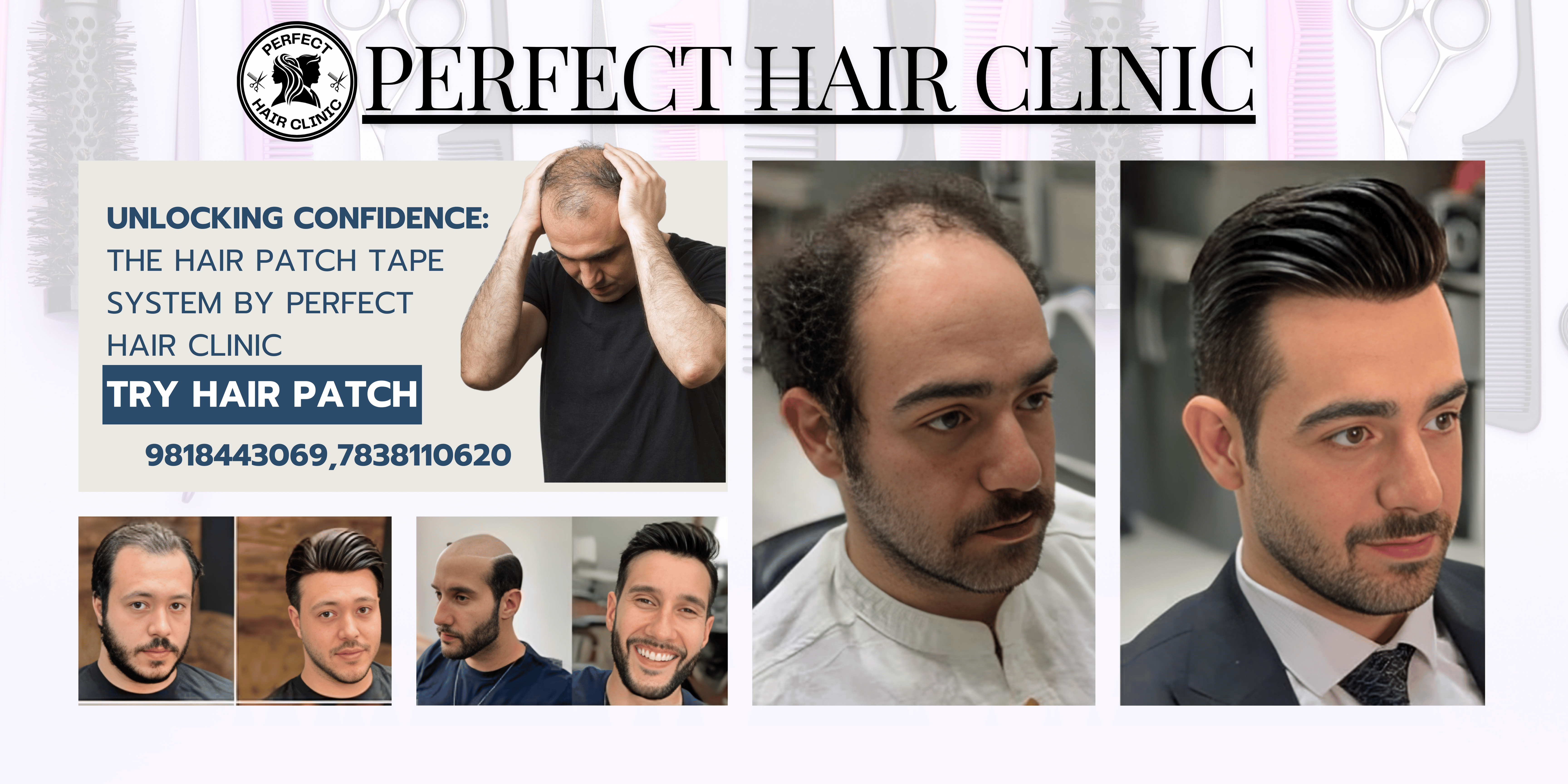 Best hair patch service in south delhi