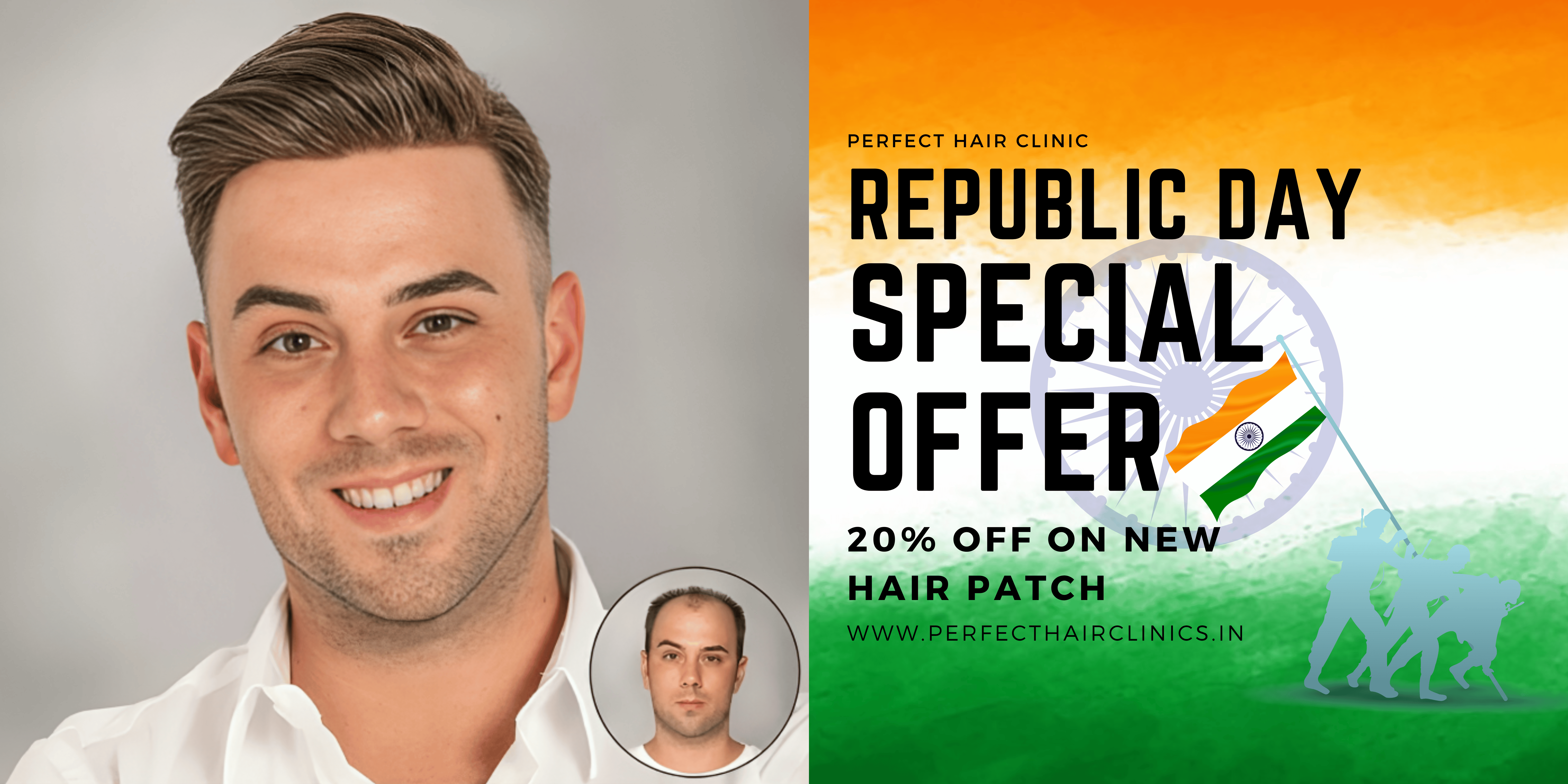 Best Hair Patch Fixing in Delhi.