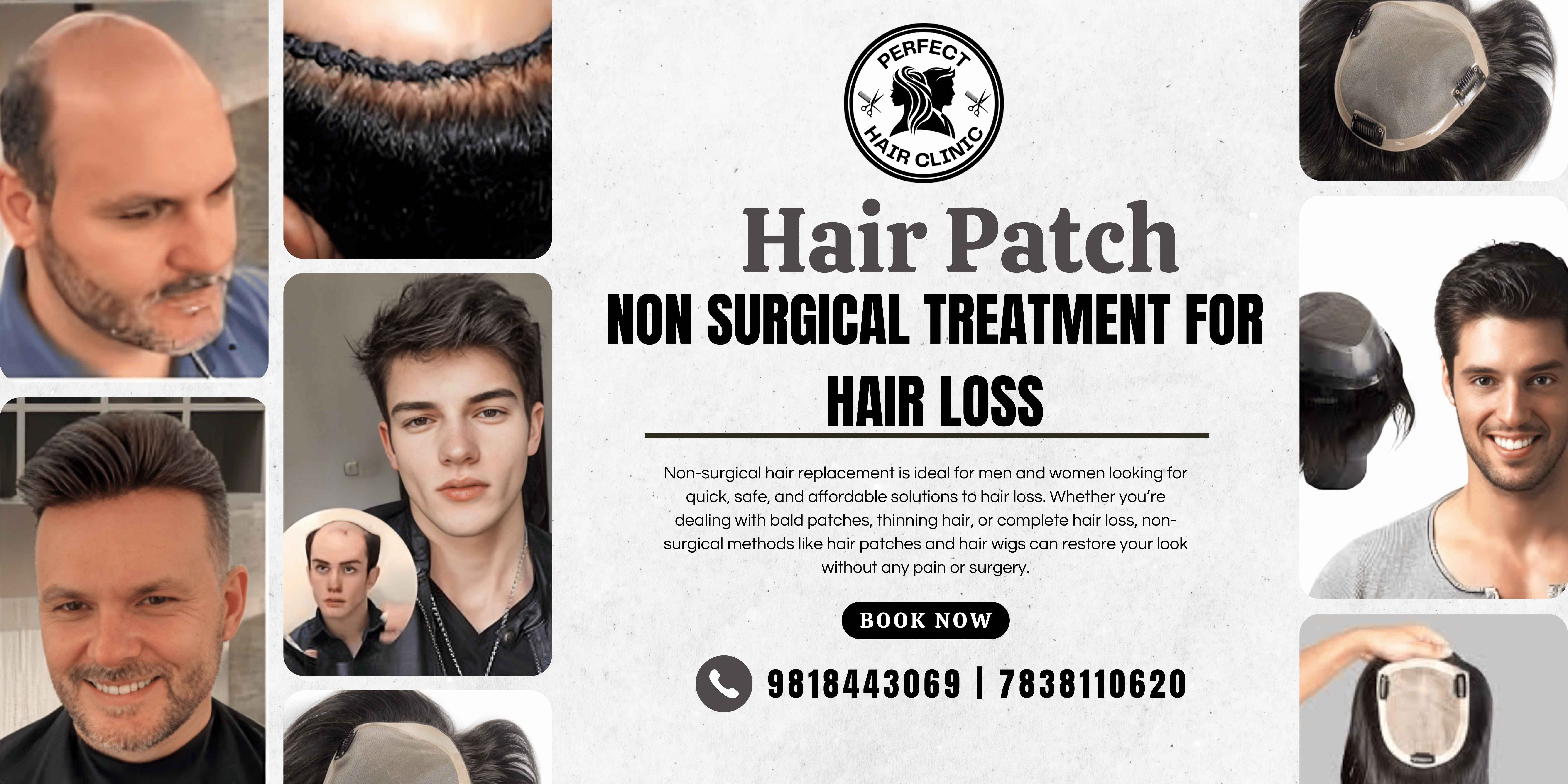 Best Hair Patch In Delhi