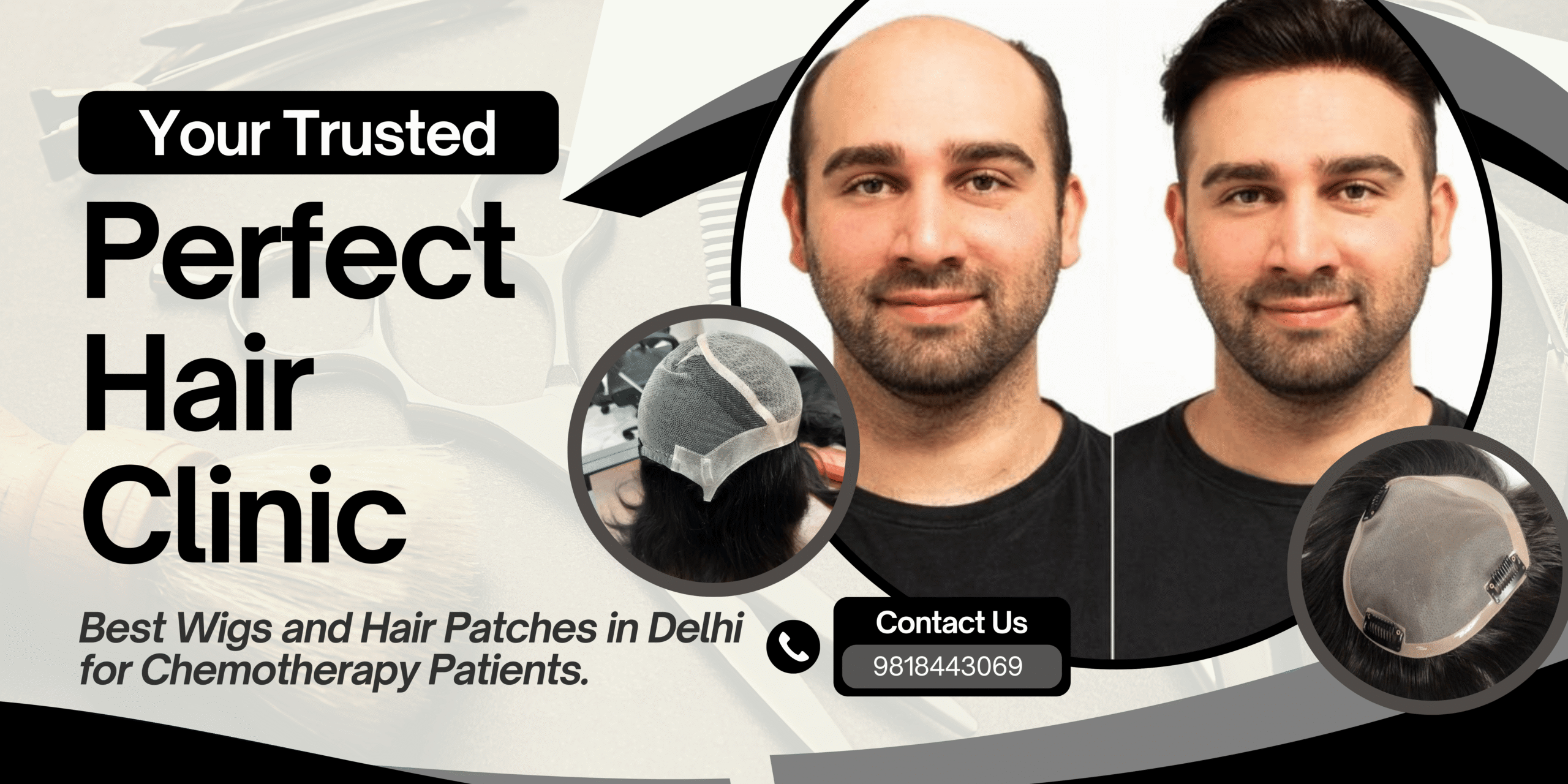 Best hair patch fixing in delhi