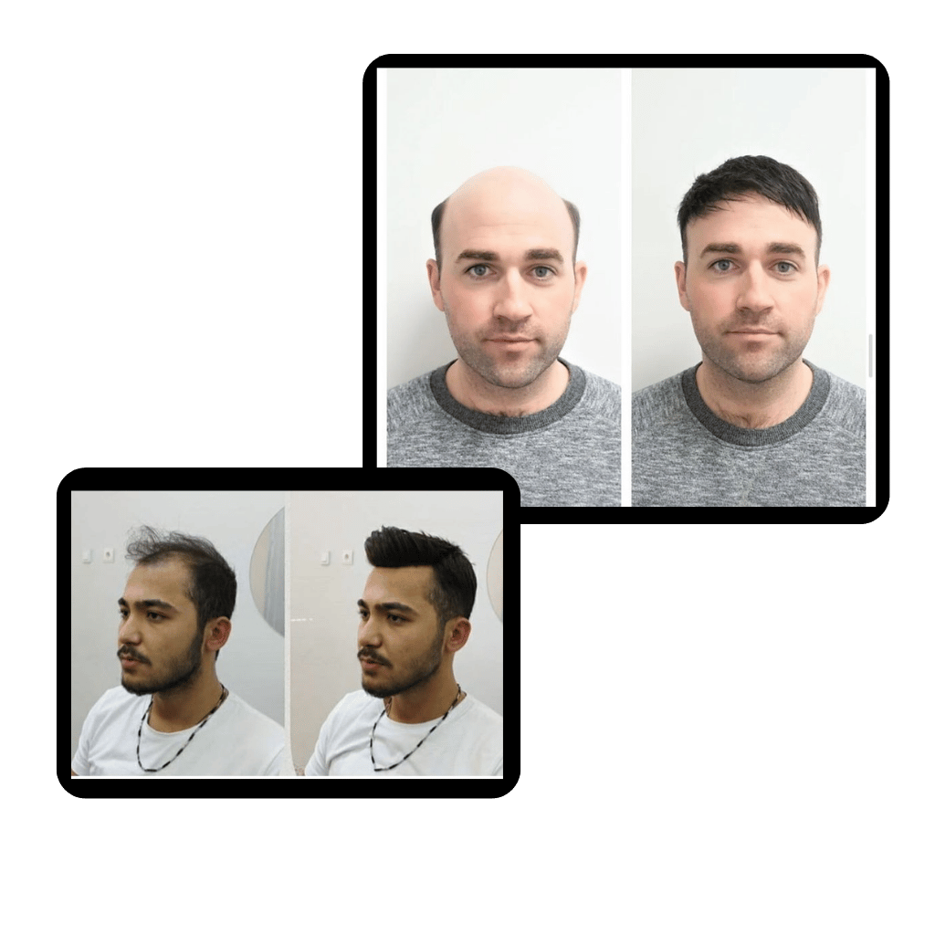 Best Hair Patch Glue Service in Delhi